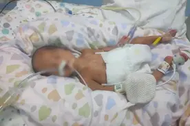 命悬一线！1岁早产男婴身患重病，出院又遭意外呼吸衰竭图片