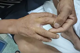 小伤口可能潜藏大风险！男子不慎割伤手指，数月后确诊败血症、全身多处感染图片