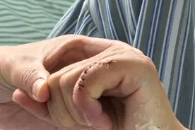 老人小指“罢工”五个月，上海六院专家为其实施小关节置换术重启手指活力图片