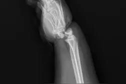 宁波一年轻妈妈拔河时为更好发力麻绳绕手，不料手腕被绞断图片