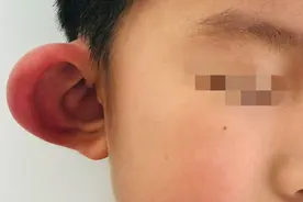 儿童面部、耳朵水肿怎么了？当心秋蚊猛如虎图片