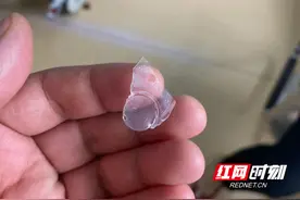 猛喝奶茶误吞破碎杯盖 医生巧手取异物化险为夷图片