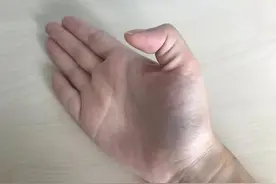 永医科普丨医生，我的大拇指疼痛图片