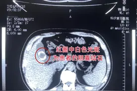 67岁老嗲嗲酷爱“油拌面”，胆囊长出“鹌鹑蛋”大小的结石图片