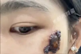 女子一个“小动作”，结果脸上溃烂进了急诊，严重可致死亡……图片