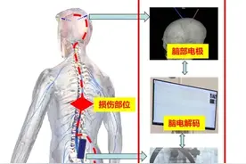全球首例奇迹！在上海！完全截瘫患者恢复站立行走！全靠在这里植入电极图片