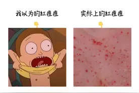 胸前长了小米粒的“红痘”，要挤出来吗？图片