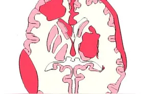 男子酒醉后呕吐，不料竟是脑出血！医生：这种呕吐要小心图片