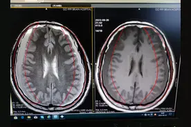 小学生考试答一题空一题，一查竟是脑肿瘤图片