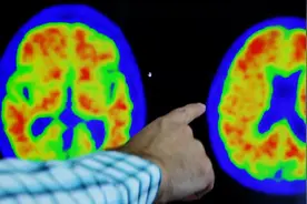 器官移植会传播阿尔茨海默病？图片