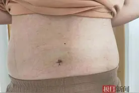 “脆皮”大学生一个蹲起后就站不起来，原是腰椎间盘突出图片