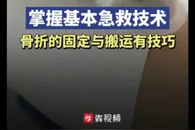 掌握基本急救技术，骨折的固定与搬运有技巧图片
