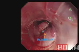 七旬婆婆凌晨大量呕血命悬一线，竟是一把花生惹的祸图片