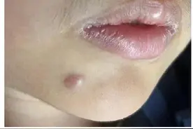 爸爸带娃街边点痣反致脸上长个大包图片