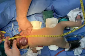 发病率亿分之7！会吞噬血小板，武汉男婴出生6天顺利切除罕见血管瘤图片