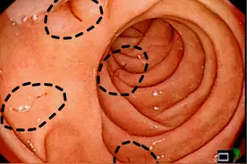 老人莫名严重贫血治疗五年“无解”，竟是肠道内十余条钩虫在“吸”血图片