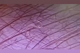 11岁女孩反复腹痛求医，切开阑尾后竟有虫子游出……图片