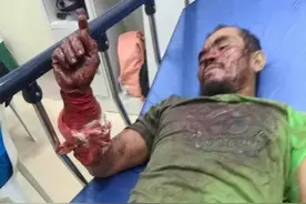 菲律宾男子咬死3米巨蟒：遭蟒蛇咬伤缠身后，他狠咬蛇脖子自救图片