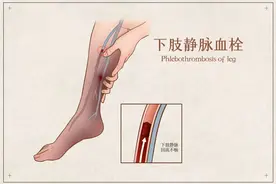 久坐不动血管也会“堵”！出现这些症状当心血栓找上门！2个动作教你预防！图片