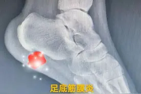 跑完步后出现脚后跟疼痛？如何应对足底筋膜炎图片