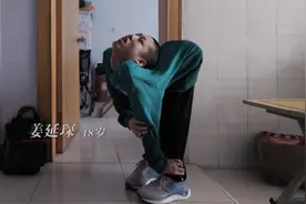 中国&世界首例Z字折叠男孩姜延琛，超高难度手术惊心动魄图片