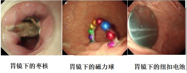 真吞金兽！11岁男童如厕拉出10克重金豆，妈妈吐槽：每天提醒他不能在外面拉