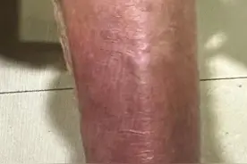 警惕！有人被叮咬后染上丹毒，医生紧急提醒！图片