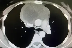 惊险！17岁女孩胸闷气短，竟是因6斤大的恶性肿瘤！这些症状别忽视→图片