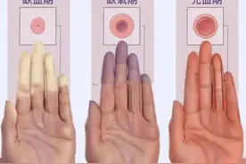 白→紫→红，警惕手脚异常变色！20~40岁女性高发图片