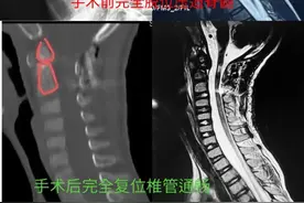 福建7岁男童突然高位截瘫！CT上看就像成了“断头人”！这病严重可致命图片