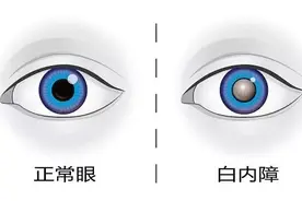 【健康连线】眼睛看不清，是老花眼还是白内障？这里教您轻松辨别→图片