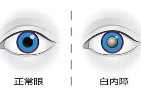 【健康连线】眼睛看不清，是老花眼还是白内障？这里教您轻松辨别→图片