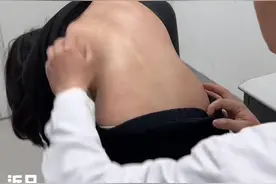 13岁女孩脊柱侧弯达80度！ 医生提醒，这个病女性发病率远高于男性图片