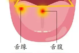 为什么有的口腔溃疡，用了药也不见好？图片