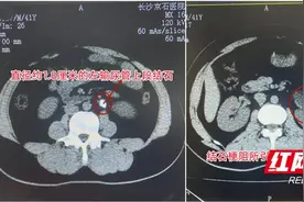 男子腰部一痛就按摩缓解 竟致结石引发肾积水还卡伤输尿管图片
