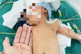 福建首例！宝宝出生仅6天，嘴唇变“青”差点夭折！省立医生挑战高难度手术救了他图片