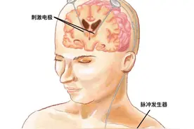 国内首例！上海医生为癫痫患者植入具感知功能的“脑起搏器”图片