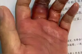 被鱼鳍刺伤可能导致严重后果！处理海产品警惕海洋创伤弧菌偷袭图片