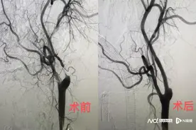 广东省人民医院成功开展华南首例颈动脉狭窄治疗新技术图片