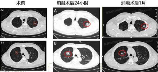 全球首例！浙大邵逸夫医院用AI机器人“一站式”精准歼灭双肺高危病灶