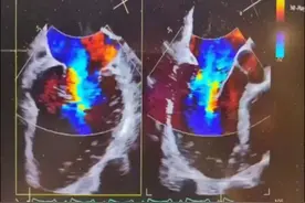 首例！重医附二院成功实施经导管二尖瓣钳夹术，更多患者将获治疗新希望图片