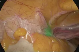 小“哨兵”解决大问题！前哨淋巴结助力精准微创图片