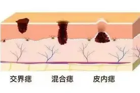 黑痣“变形记”，警惕恶变的五大信号！图片