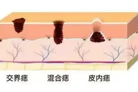 黑痣“变形记”，警惕恶变的五大信号！图片