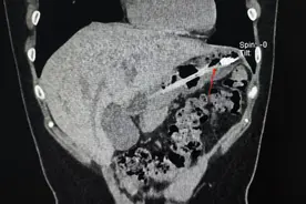 上海一女子减肥变厌食症，体重只剩40余斤！还有人催吐误吞18cm牙刷！医生提醒图片
