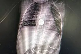 惊险！云南1岁幼儿误吞纽扣电池！食管已溃疡图片