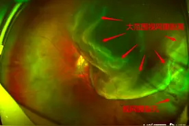 近视2000度的孕妇左眼突然看不清了，原因是……图片