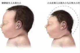 这种病毒可能导致新生儿小头畸形，你知道吗？图片