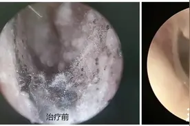 女子瘙痒难忍听力下降，竟是耳朵里“发霉长毛”了图片