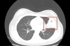 杭州11岁女孩高烧40℃，出现大白肺！爸妈一个举动致病情加重图片
